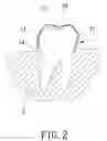 Fig. 03 - INVISIBLE PLASTIC TEETH BRACE FOR ORTHODONTICS