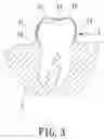 Fig. 04 - INVISIBLE PLASTIC TEETH BRACE FOR ORTHODONTICS