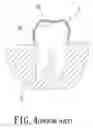 Fig. 05 - INVISIBLE PLASTIC TEETH BRACE FOR ORTHODONTICS