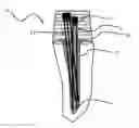 Fig. 01 - Reinforcing structure for coronal-radicular dental restoration, method for carrying out coronal-radicular dental restoration, and coronal-radicular restoration