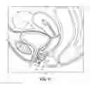 Fig. 13 - Intravaginal support devices and methods
