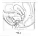 Fig. 14 - Intravaginal support devices and methods