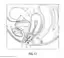 Fig. 15 - Intravaginal support devices and methods