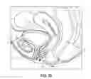Fig. 62 - Intravaginal support devices and methods
