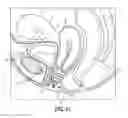 Fig. 64 - Intravaginal support devices and methods
