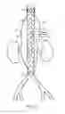 Fig. 10 - Vascular prosthesis with fenestration ring and methods of use