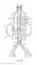Fig. 18 - Vascular prosthesis with fenestration ring and methods of use