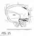 Fig. 29 - Device, system, and method for transcatheter treatment of valvular regurgitation
