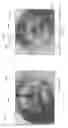 Fig. 35 - Device, system, and method for transcatheter treatment of valvular regurgitation