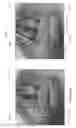 Fig. 37 - Device, system, and method for transcatheter treatment of valvular regurgitation