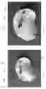 Fig. 41 - Device, system, and method for transcatheter treatment of valvular regurgitation