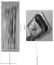 Fig. 42 - Device, system, and method for transcatheter treatment of valvular regurgitation