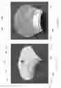 Fig. 65 - Device, system, and method for transcatheter treatment of valvular regurgitation