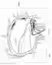 Fig. 74 - Device, system, and method for transcatheter treatment of valvular regurgitation