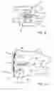 Fig. 03 - Continuous compression fixation device for the fusion of an intercalary structural augment