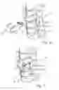 Fig. 05 - Continuous compression fixation device for the fusion of an intercalary structural augment