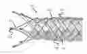 Fig. 01 - Vessel prosthesis