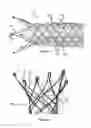 Fig. 02 - Vessel prosthesis