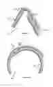 Fig. 05 - Vessel prosthesis