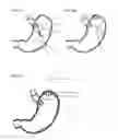 Fig. 07 - Magnetic Device For Stimulating the Vagus Nerve