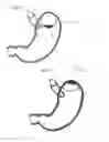 Fig. 08 - Magnetic Device For Stimulating the Vagus Nerve