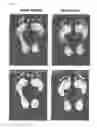 Fig. 05 - Orthotic appliance