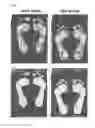 Fig. 07 - Orthotic appliance