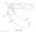 Fig. 07 - Oral appliance