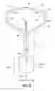 Fig. 03 - Dual balloon fluid endometrial treatment of uterine tissue