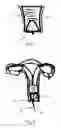 Fig. 05 - MENSTRUAL COLLECTION PRODUCT