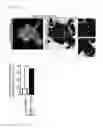 Fig. 23 - Nuclear paraspeckle assembly transcript 1 as therapeutic targeting in neurodegeneration