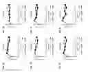 Fig. 02 - Genetically stable live attenuated respiratory syncytial virus vaccine and its production