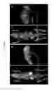 Fig. 09 - Compositions for use in diagnosing and treating melanoma, including metastatic melanoma and methods related to same