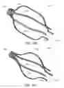 Fig. 110 - Conduit tips and systems and methods for use
