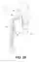 Fig. 55 - Conduit tips and systems and methods for use