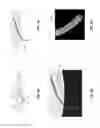 Fig. 14 - Helical insertion infusion device