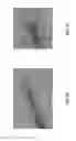Fig. 15 - Helical insertion infusion device