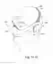 Fig. 52 - DELIVERY OF RESPIRATORY THERAPY