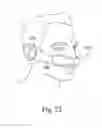 Fig. 71 - DELIVERY OF RESPIRATORY THERAPY