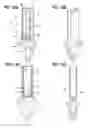 Fig. 13 - Methods of dispensing a urinary catheter from a sterile package