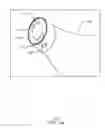 Fig. 15 - Balloon catheter