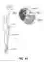 Fig. 14 - PERCUTANEOUS LEAD