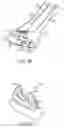 Fig. 14 - NASAL STIMULATION DEVICES AND METHODS FOR TREATING DRY EYE