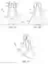 Fig. 15 - NASAL STIMULATION DEVICES AND METHODS FOR TREATING DRY EYE