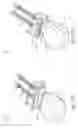 Fig. 30 - NASAL STIMULATION DEVICES AND METHODS FOR TREATING DRY EYE