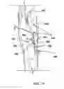 Fig. 23 - System and method to percutaneously block painful sensations