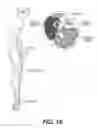 Fig. 14 - System and method to percutaneously block painful sensations