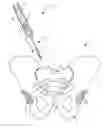 Fig. 01 - Implantable electrical stimulator with deflecting tip lead