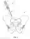Fig. 02 - Implantable electrical stimulator with deflecting tip lead