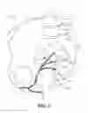 Fig. 03 - Implantable electrical stimulator with deflecting tip lead
